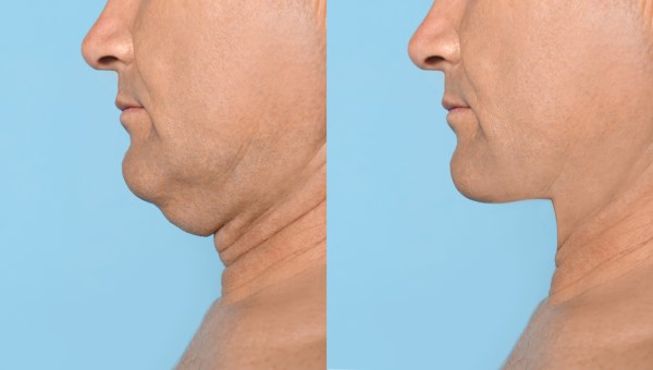 Which Non-Surgical Treatments Work Best for Jowls and Loose Skin Warminster?