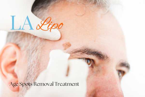 What Are the Most Effective Treatments for Age Spots Warminster?