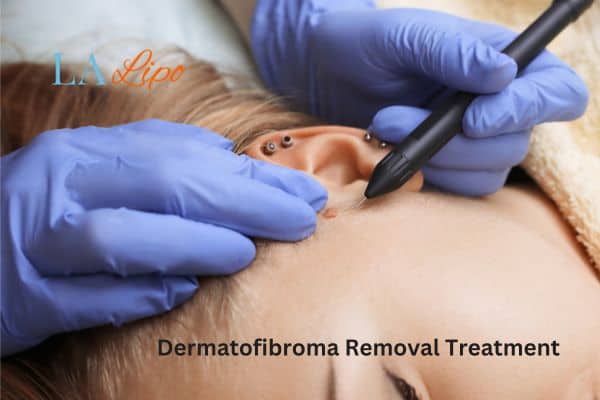 Dermatofibroma Removal Treatment Warminster