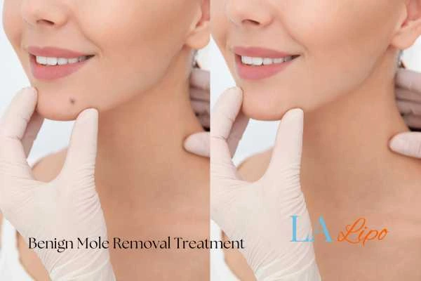 Before-and-after results following benign mole-removal treatment Warminster