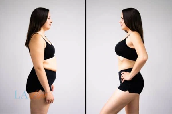 image of woman before and after results of LA-EMS Body Sculpting Warminster to help treat Diastasis recti