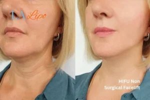 hi-fu for wrinkles Warminster before and after results