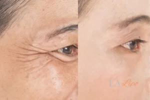 Before and after results of woman - HI-fu wrinkles reduction treatment Warminster