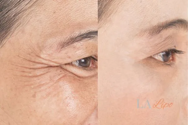 Before and after results of woman - HI-fu wrinkles reduction treatment Warminster