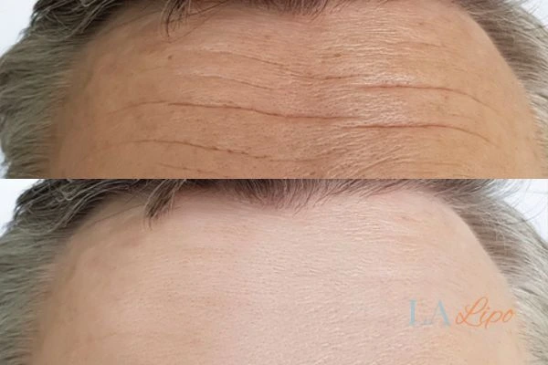 results of HIFU Warminster on mans forehead to help reduce lines and wrinkles