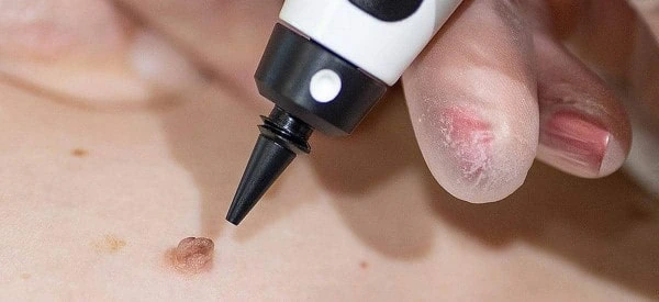 skin tag removal using cryopen Warminster