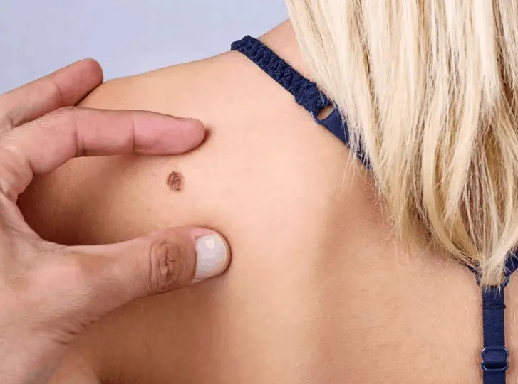 woman having mole removal Warminster consultation before treatment.