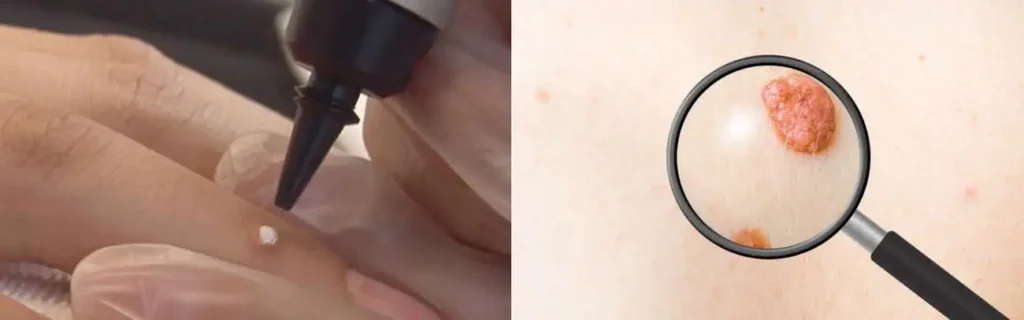 Cryopen for mole removal Warminster - speak to our team today!
