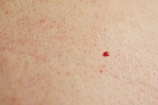 close up of a cherry angioma Warminster