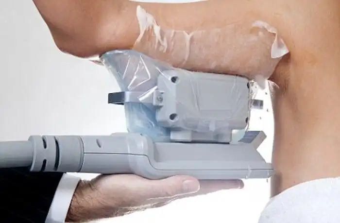Picture of fat freezing Warminster on the upper arms.