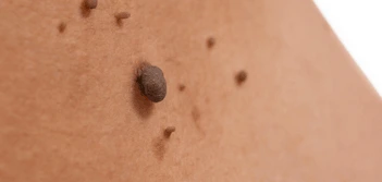 image of a skin tag Warminster