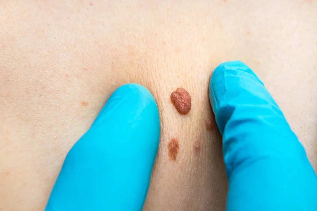 Consultant examining a skin tag Warminster