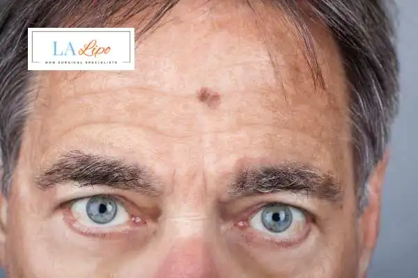 Solar Lentigo Removal Warminster image of man with mark on his forehead