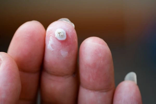 wart on person finger - cryotherapy to treat from LA LIPO Warminster