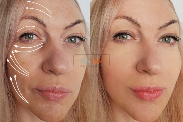 Morpheus 8 results Warminster face lift.