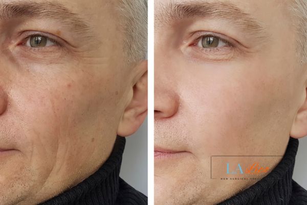 See the amazing results of Morpheus8 Treatment Warminster!