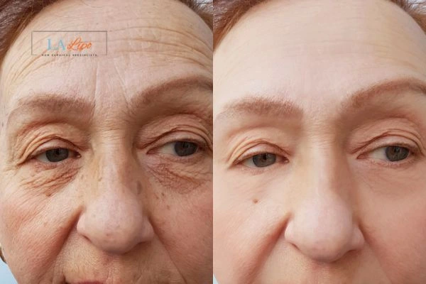 The powerful benefits of Morpheus8 Treatment Warminster - Call Our team today!