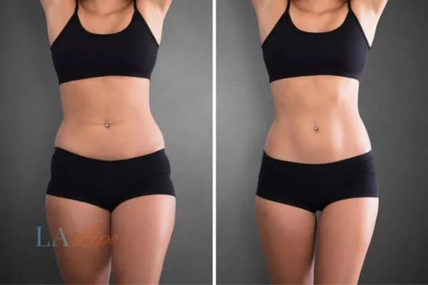 before and after results of non-surgical treatment to help a woman's body image and mental health Warminster