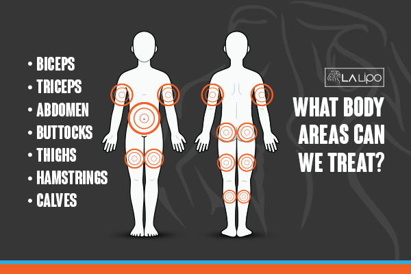 Diagram to show areas you can have LA-EMS Body Sculpting Treatment Warminster
