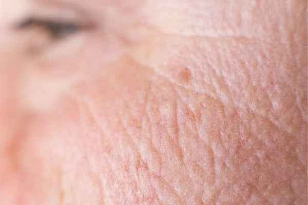 close up picture of a woman's face showing an age spot Warminster