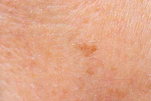 close up picture of age spots Warminster