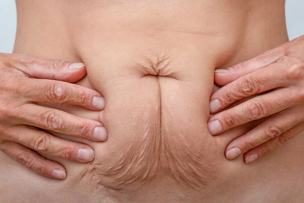 Should I Combine Diastasis Recti Treatment with Body Contouring for Better Results Warminster?