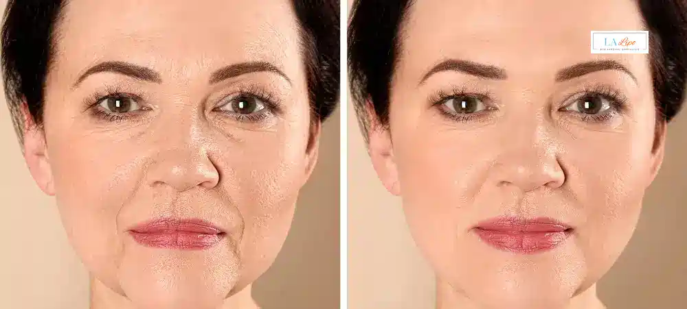 How Long Does It Take to See Results and How Long Do They Last Warminster?