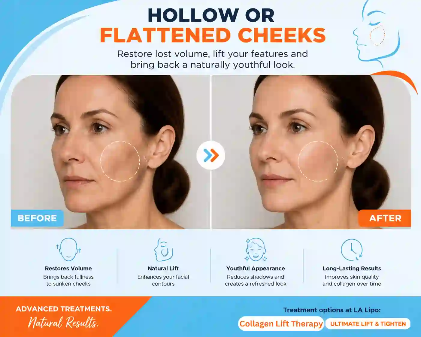 Sign #4: Hollow or Flattened Cheeks Warminster