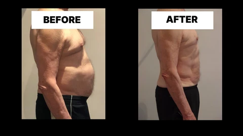 What Symptoms Can Diastasis Recti Cause in Men? Weak Core, Back Pain and Poor Posture Warminster